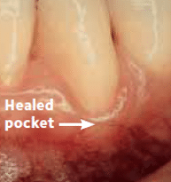 Periodontitis teeth
