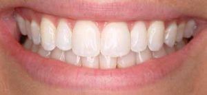 Teeth whitening