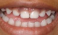 baby teeth