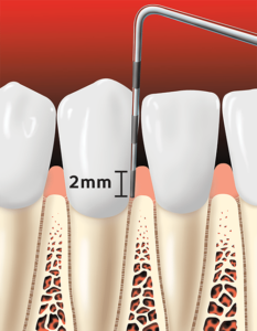 Periodontitis teeth
