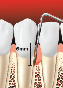 Periodontitis teeth treatment