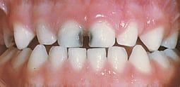Child Caries Mild Decay
