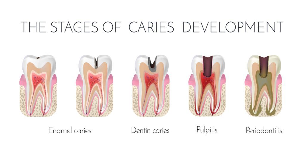 Diagram showing the various stages of cavity development