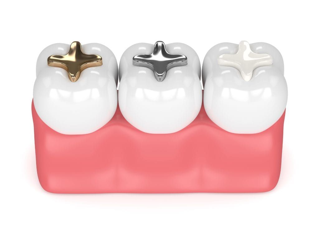 Three types of dental fillings: gold, silver, and composite