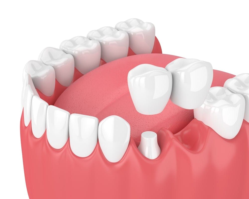 Cantilever Dental Bridge