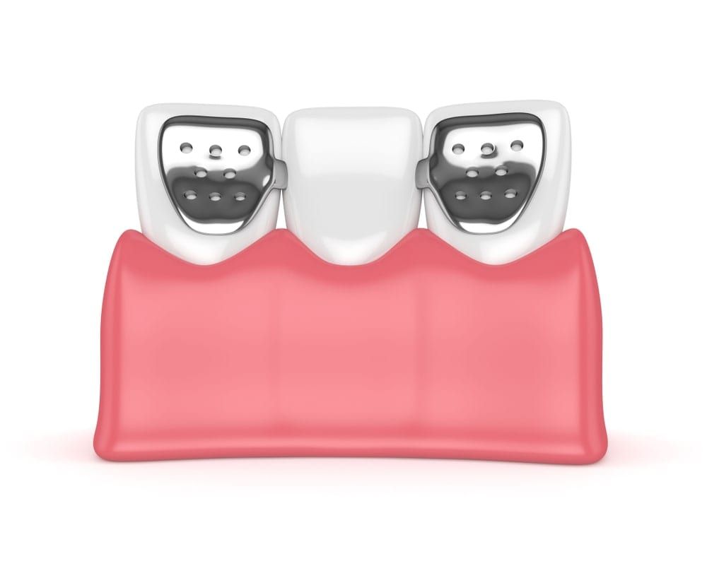Maryland Bonded Dental Bridge