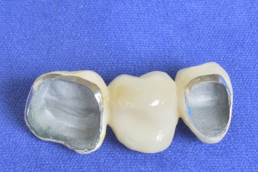 PFM Crowns Shown in a Dental Bridge