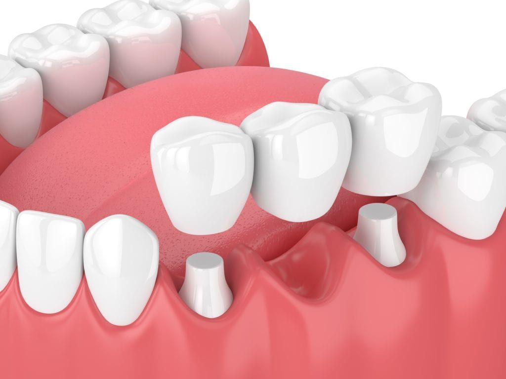 Traditional dental bridge
