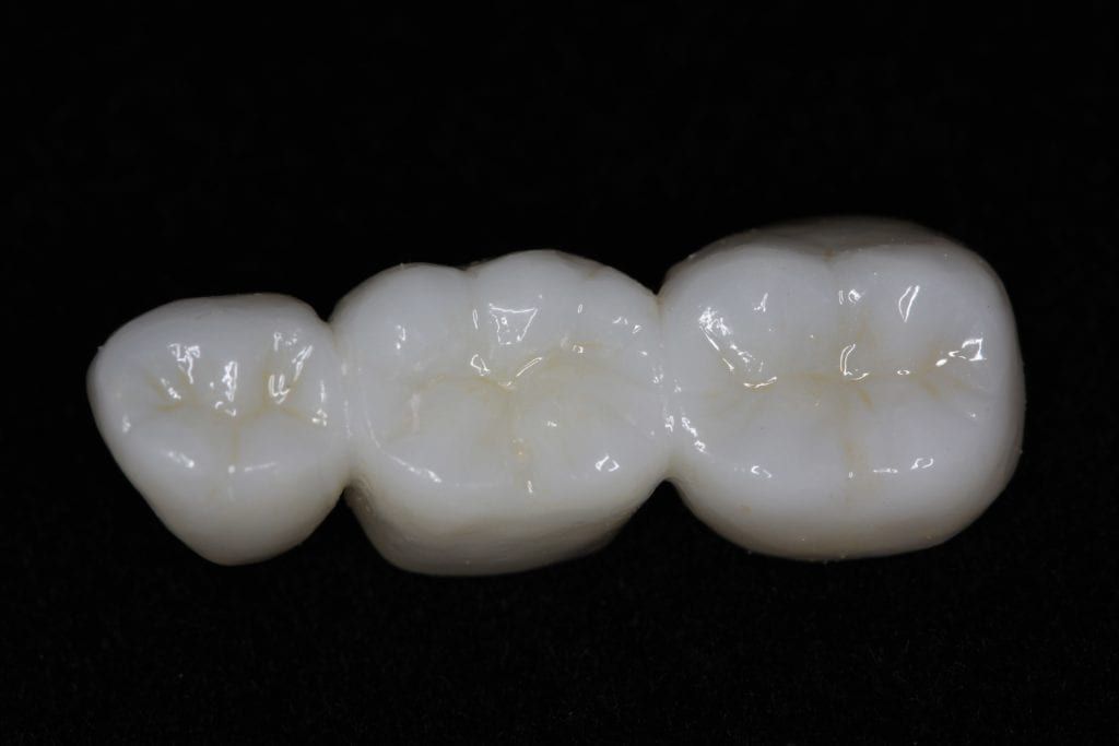 Zirconia crowns shown in a dental bridge