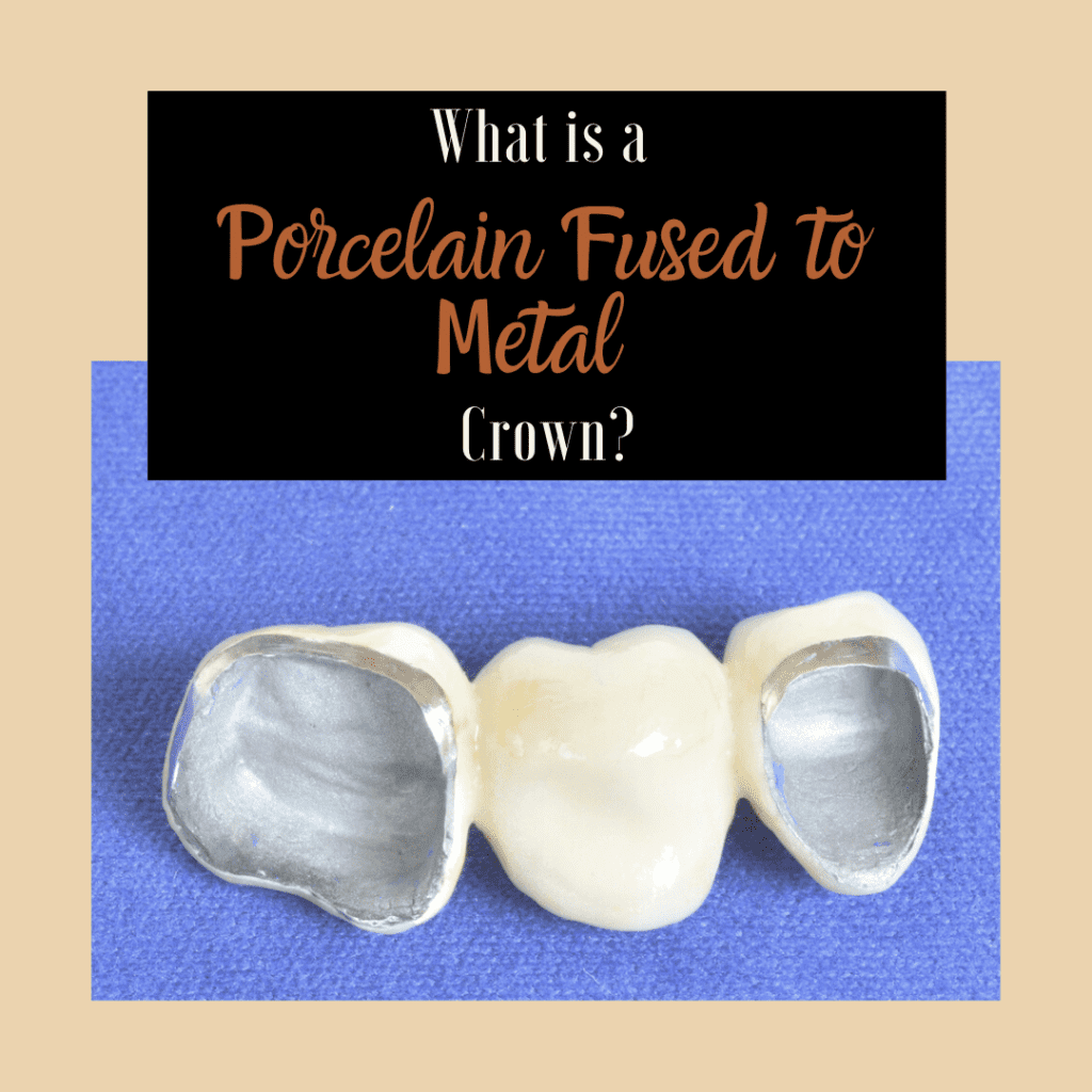What is a Porcelain Fused to Metal Crown