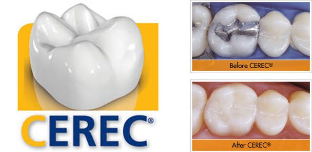 Cerec Cerec