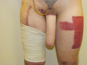 ALT Phalloplasty Photos of Results