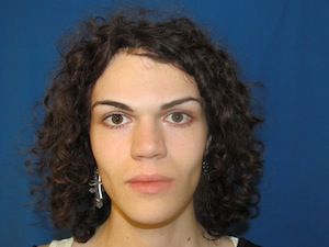 Facial Feminization Surgery Before and After Photos