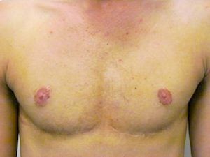 FTM Top Surgery - 1 year postop