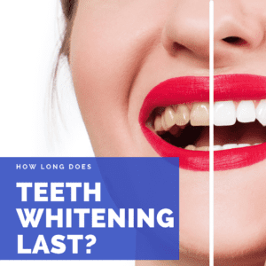 How Long Does Teeth Whitening Last?