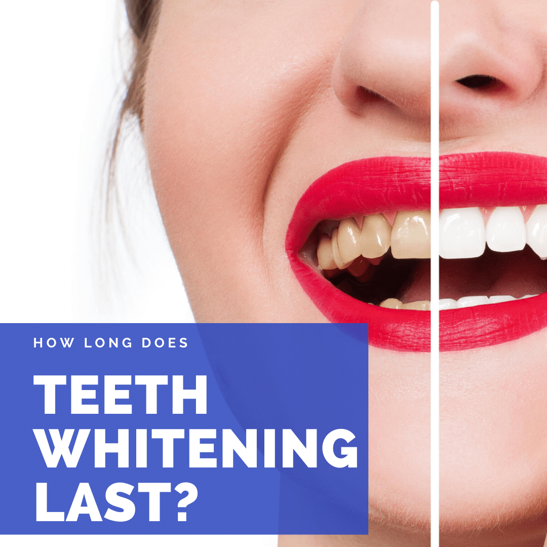 How Long Does Teeth Whitening Last?