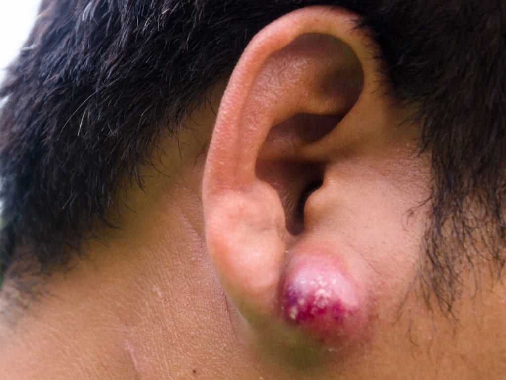 An abscess present on a patient's ear
