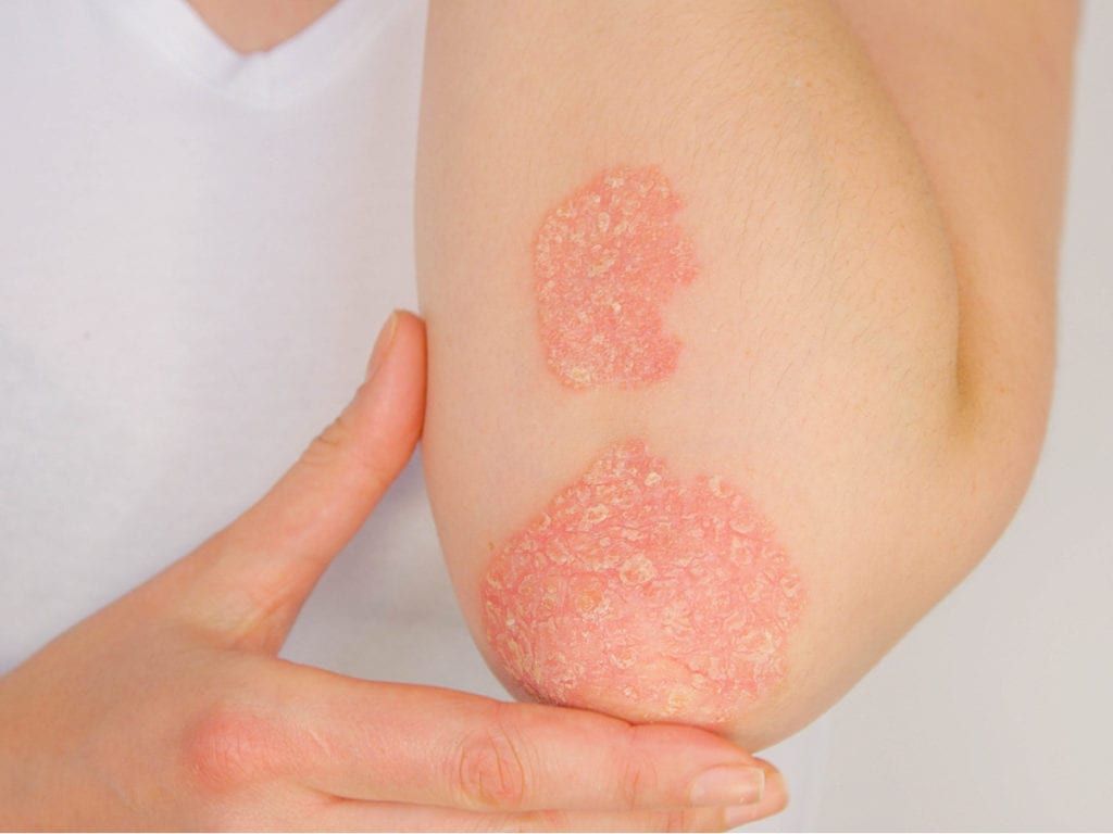 Rash on patient's elbow