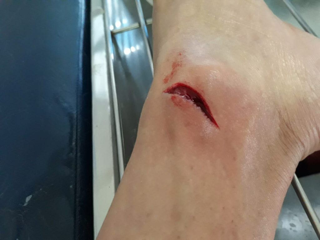 An open cut in a patients ankle