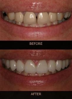 porcelain veneers and laminates