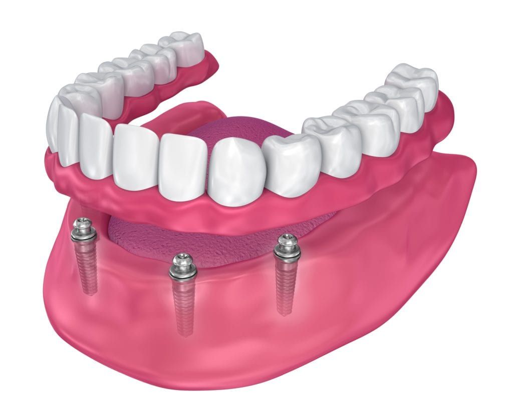 Implant Supported denture with ball retained attachments