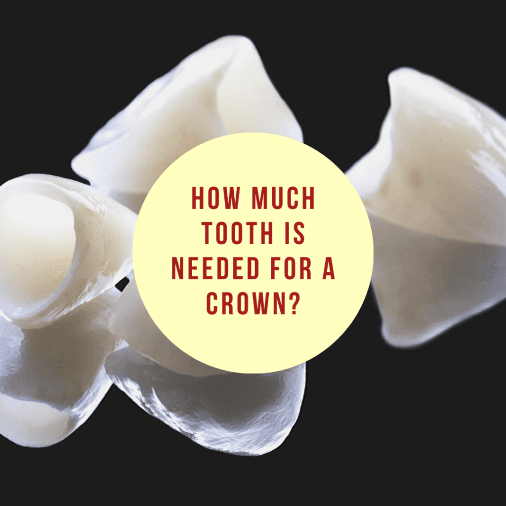 How Much Tooth is Needed for a Dental Crown? Wellington Dentist