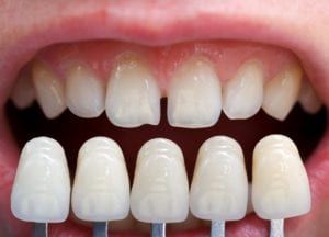 veneers being shown over natural teeth