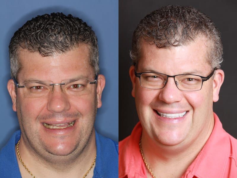 Before and After picture of TMJ Treatment