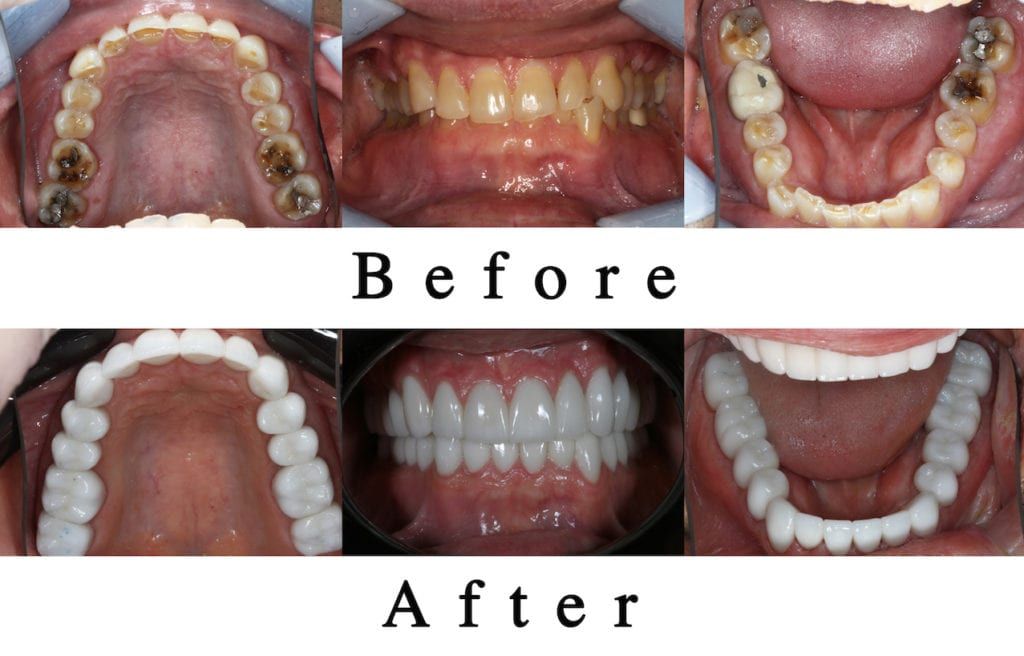 Teeth before and after TMJ Treatment