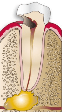 Severely decayed tooth with abscess