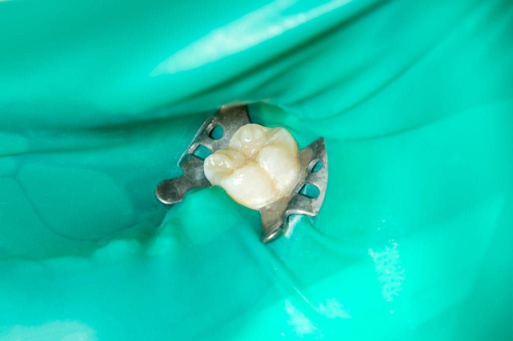 dental dam around tooth