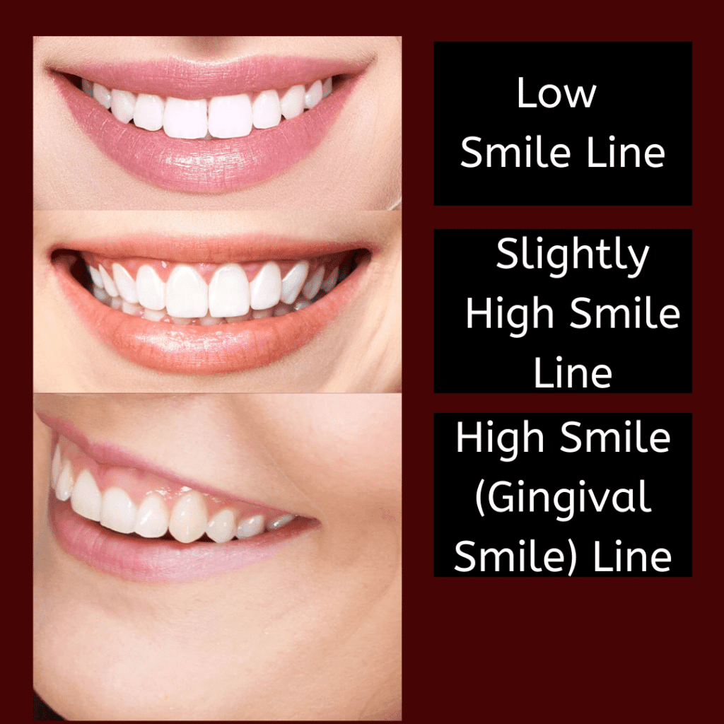 what-is-the-gingival-smile-line-wellington-dentist-west-palm-beach