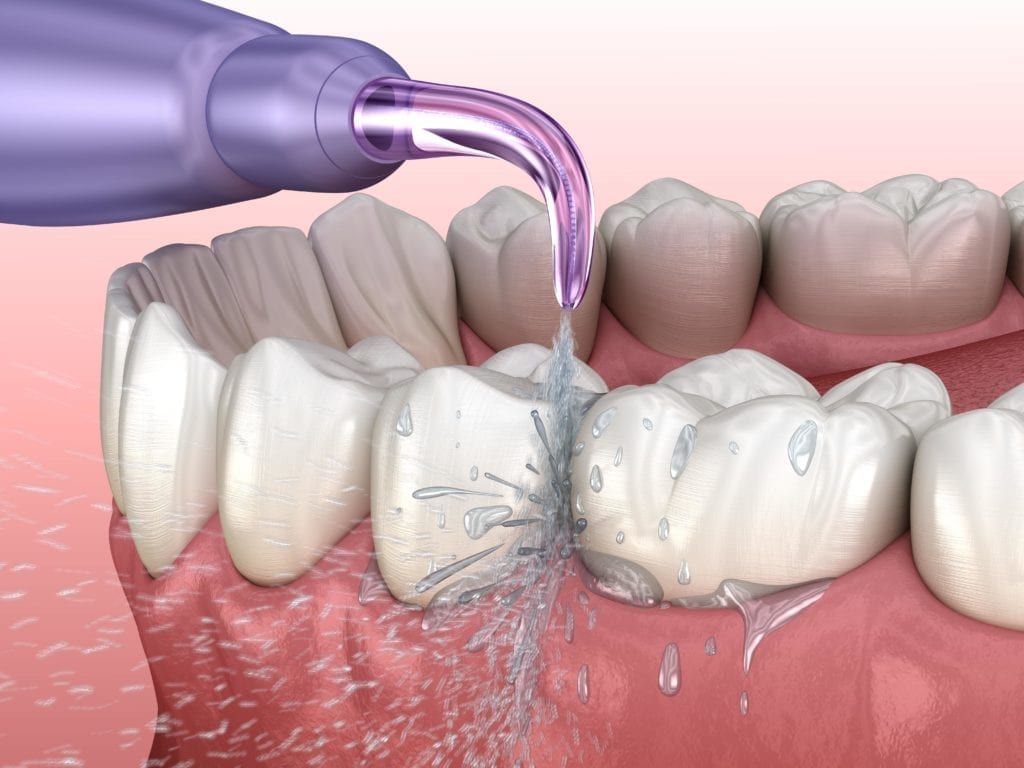 waterpik being used to water floss teeth