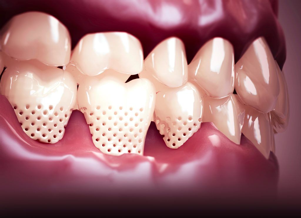 exposed tooth roots shown with holes to explain tooth sensitivity