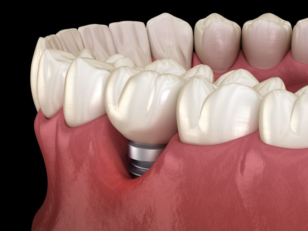 gum recession showing dental implant