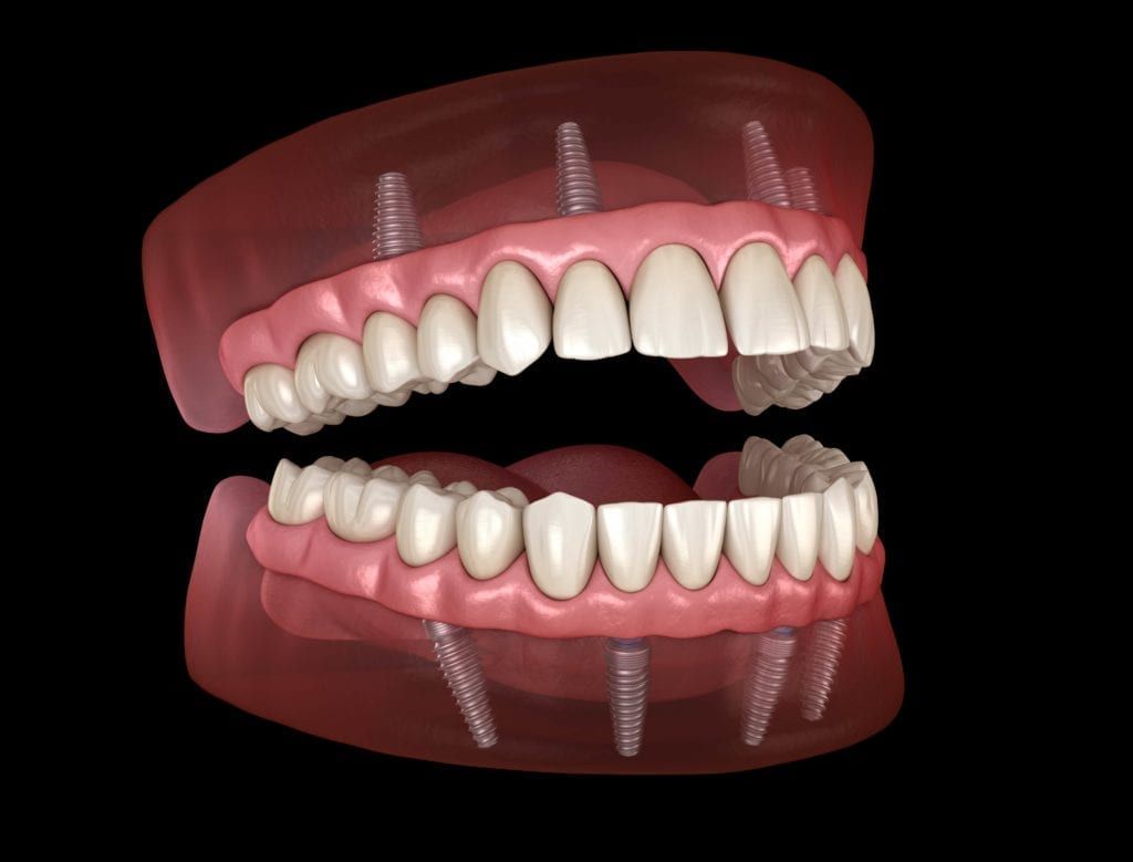 the-three-type-of-prostheses-supported-by-dental-implants