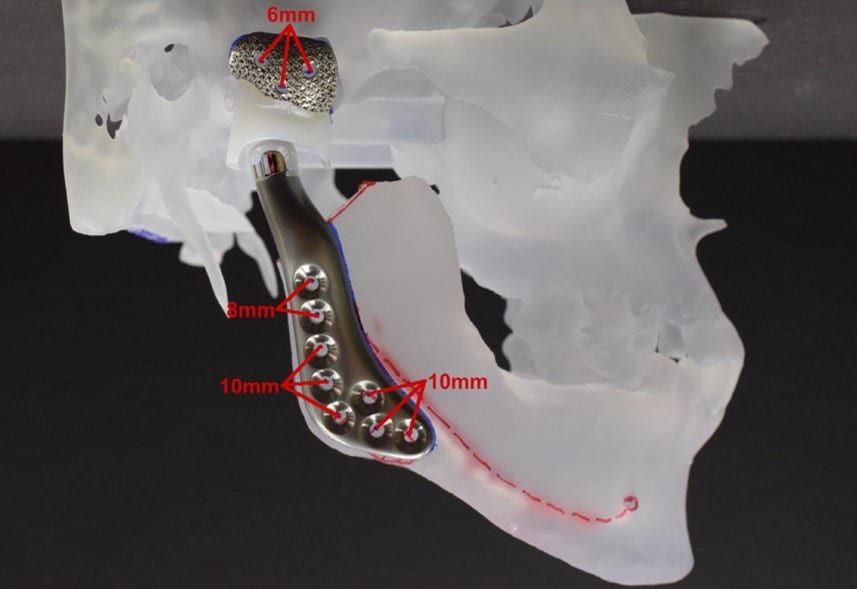 TMJ Replacement – Seattle Jaw Surgery