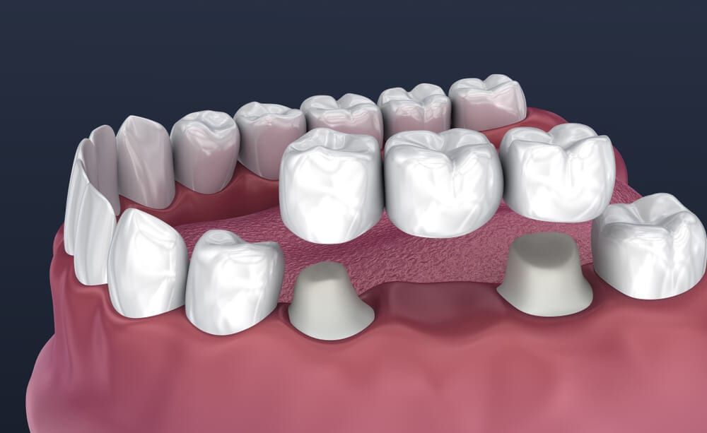 dental bridge image
