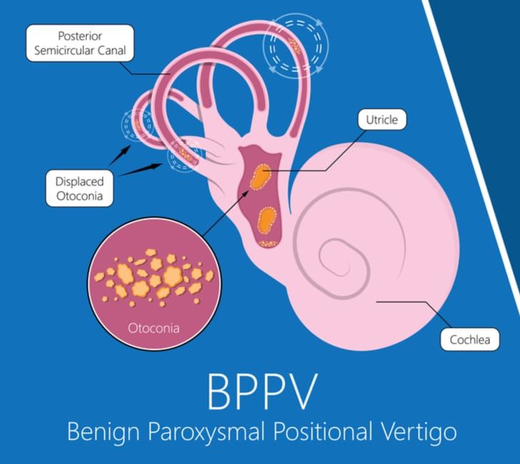 pregnancy-and-benign-paroxysmal-positional-vertigo-bppv-the-pulse