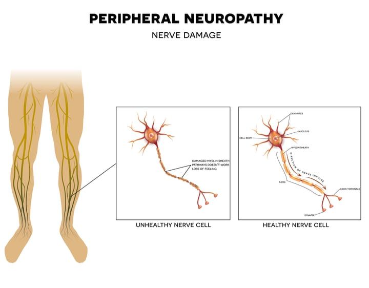 Peripheral Neuropathy - Premier Neurology & Wellness Center