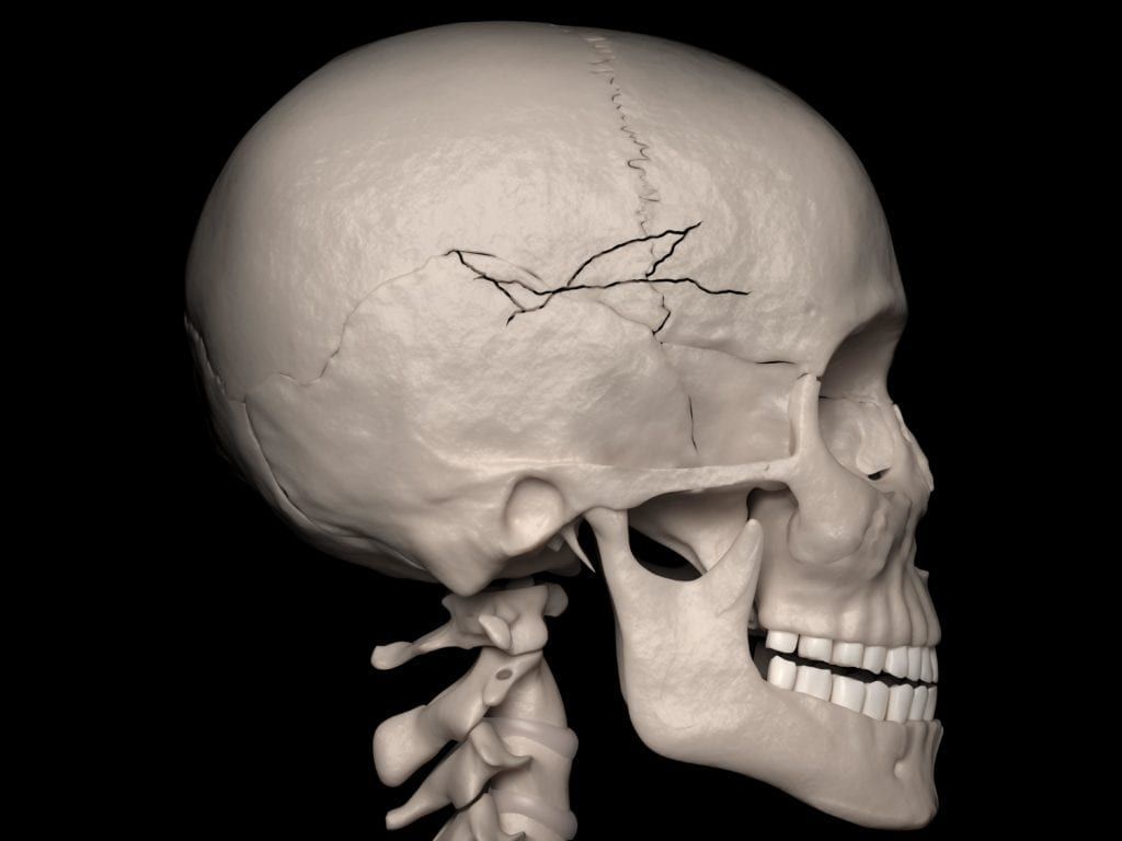 skull fracture