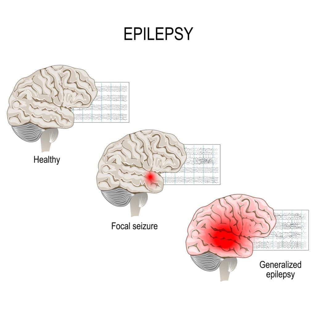 what-does-a-seizure-look-like-premier-neurology-wellness-center