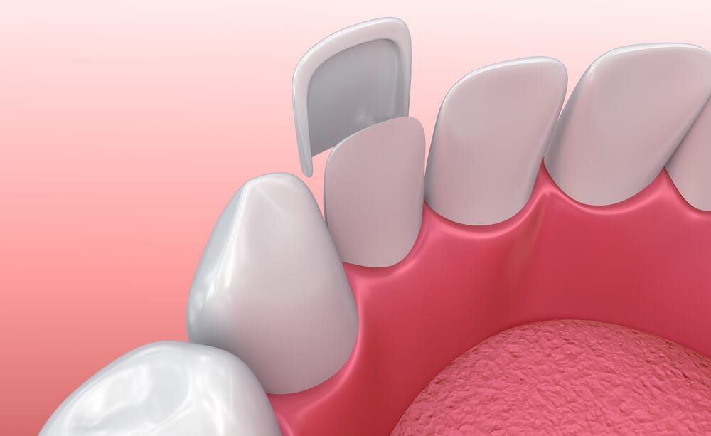 veneers on isolated background