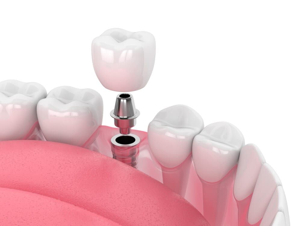 dental implant graphic