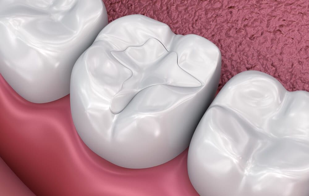 tooth filling