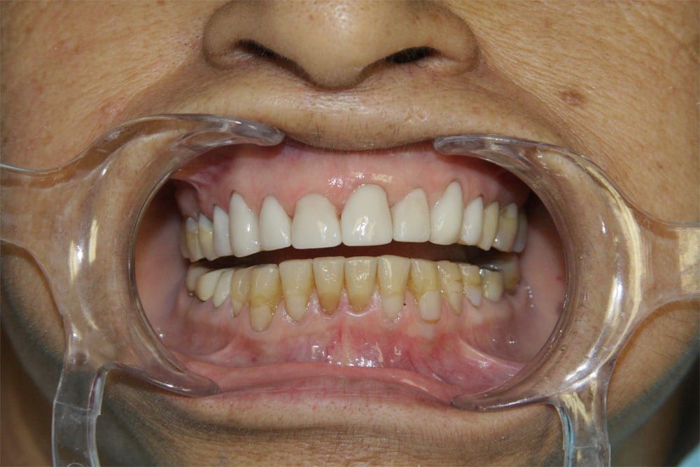 before and after photo (close shot)