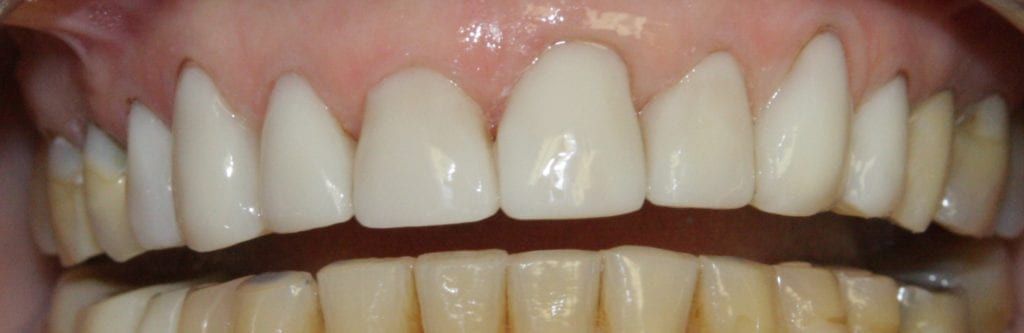 before and after photo (close shot)