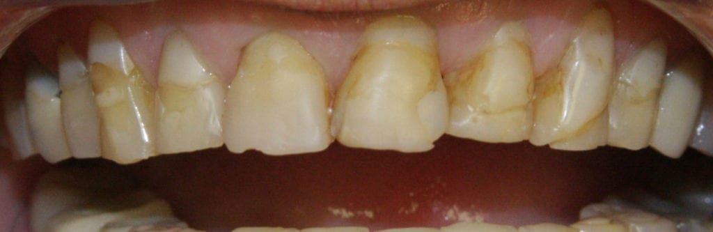 before and after photo (close shot)