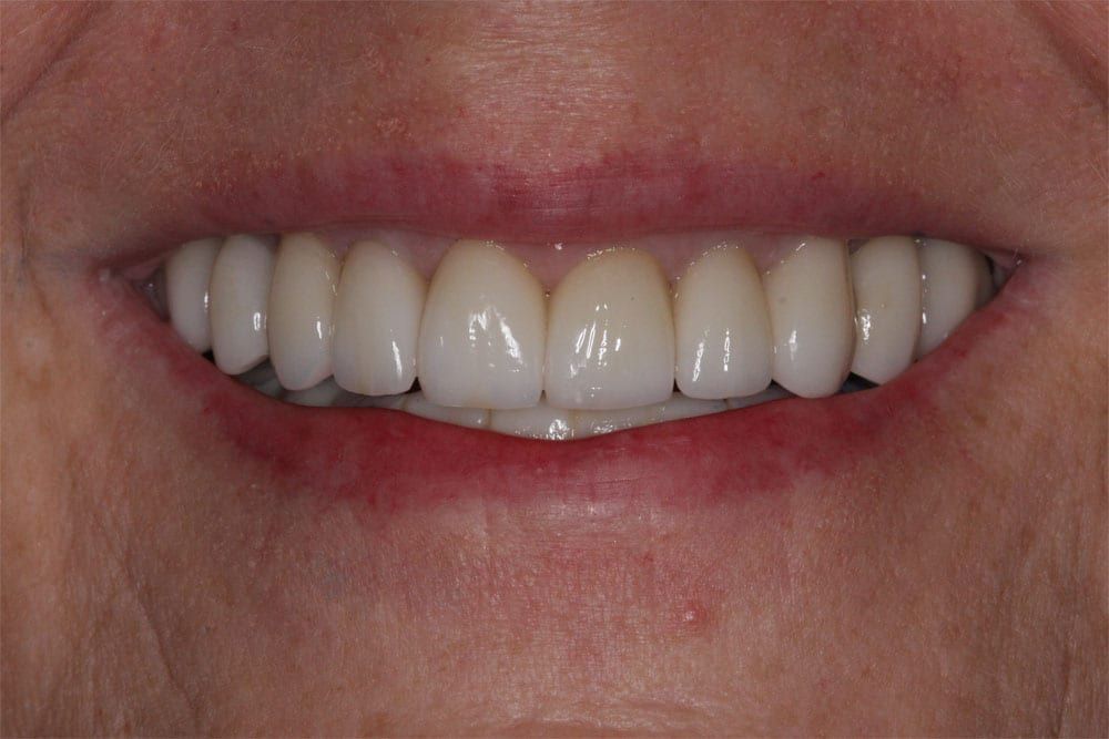 before and after photo (close shot)