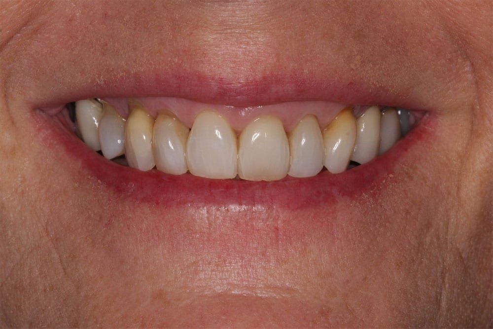 before and after photo (close shot)